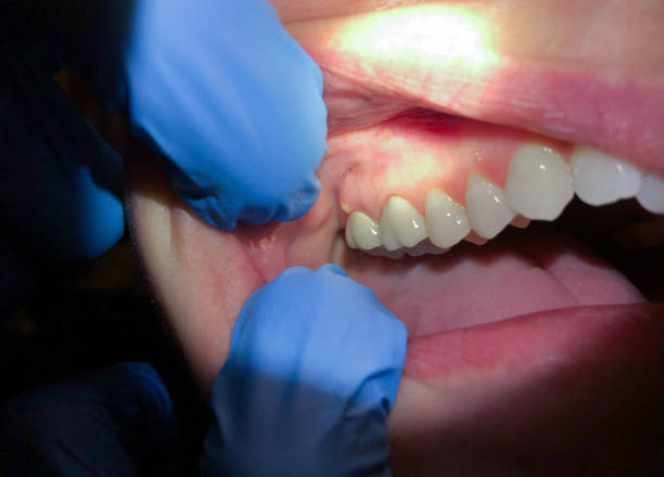 Best Emergency Dental Extractions in Horse Shoe, NC